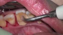 歯石取りスレ ルパン三世で五エ門が口の中を拷問されるシーンがあって